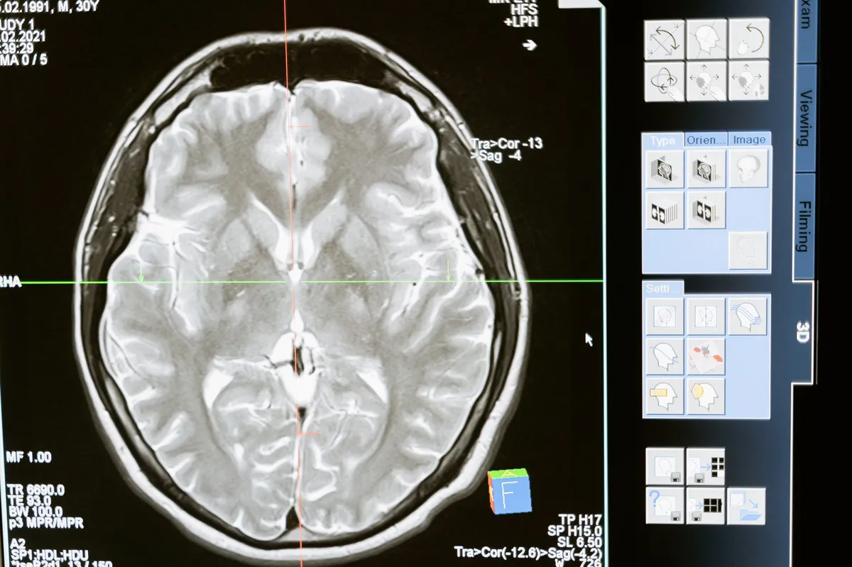 brain scan results